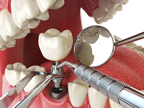 Best Emergency Dental Extractions in Venice, FL